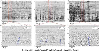 Automated Analysis Using a Bayesian Functional Mixed-Effects Model With Gaussian Process Responses for Wavelet Spectra of Spatiotemporal Colonic Manometry Signals